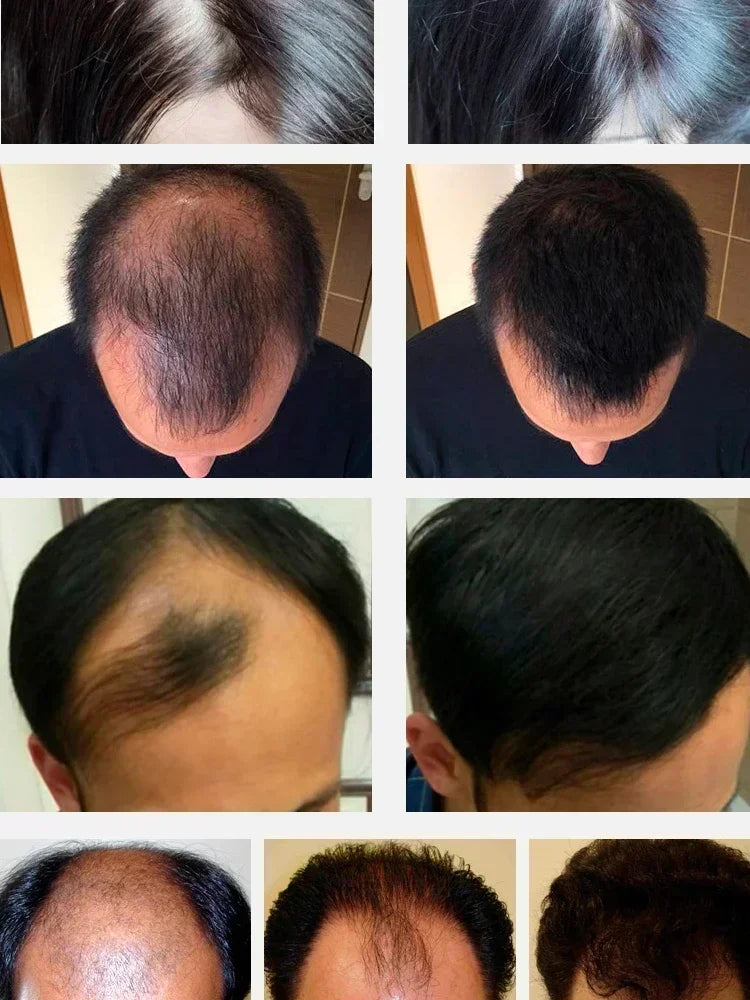 Anti Hair Loss Serum Rapid Hair Growth